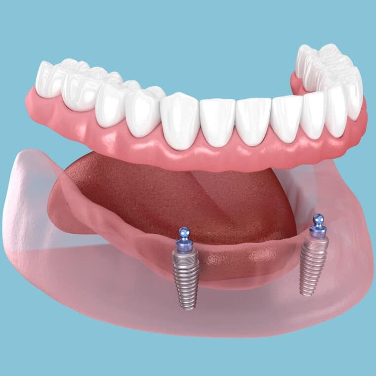 Mandibular,Removable,Prosthesis,All,On,2,System,Supported,By,Implants